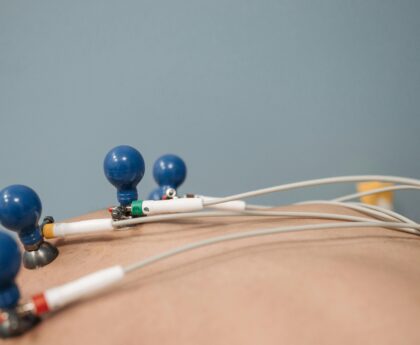 Detailed image of ECG electrodes on a patient's chest, capturing a medical procedure.