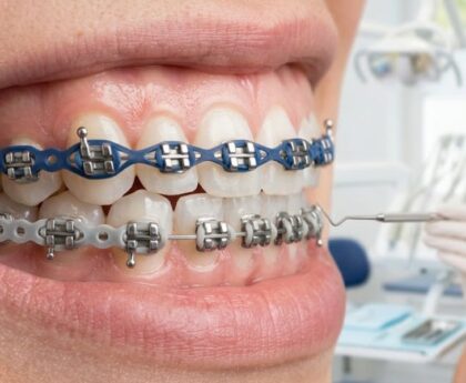 Power Chain Braces