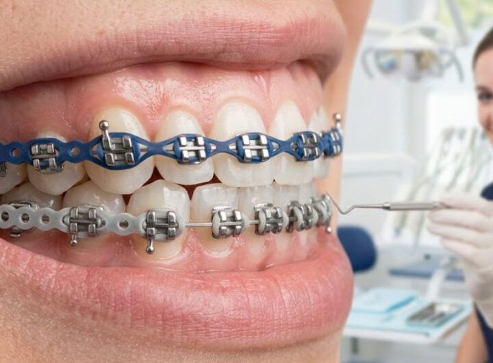 Power Chain Braces